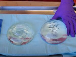 الاف الهولنديات يقاضين شركة اميركية بسبب زرعات تكبير الثدي