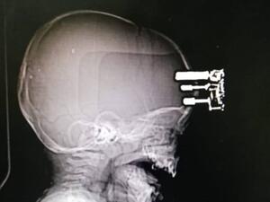 شاحن هاتف يخترق رأس طفل في السعودية