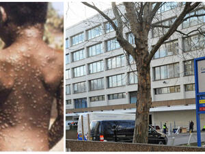 طفل بريطاني يُصاب بـ"جدري القرود"