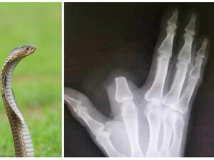 صيني يقطع أصبعه بعد لدغة أفعى والطبيب يفاجئه بحقيقة صادمة