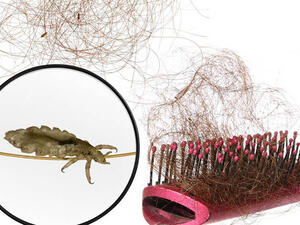 تفسير حلم القمل في الشعر للمتزوجة