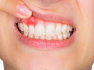 علاج التهاب اللثة وانتفاخها في المنزل
