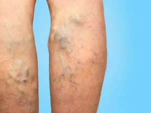 استخدام الجوارب الضاغطة من أفضل الحلول المعترف بها لعلاج الدوالي