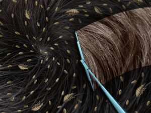 رؤية القمل في المنام وقتله