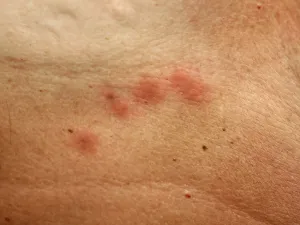 من الأسباب الأكثر شيوعاً لحدوث الطفح الجلدي تحت الثدي هي التعرق
