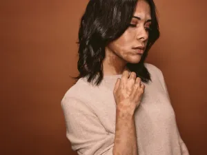 يمكن لأي شخص الإصابة بالبهاق لكن أصحاب البشرة الداكنة هم الأكثر عرضه لهذا المرض