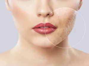 تجنب شرب المياه الغازية والمشروبات المحفوظة فهي من أهم أسباب ظهور حب الشباب