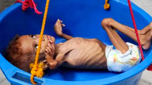Malnutrition in Yemen is rife (AFP/File Photo) 