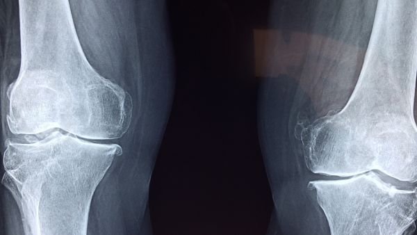 طبيب البوابة: علاج إلتهاب المفاصل