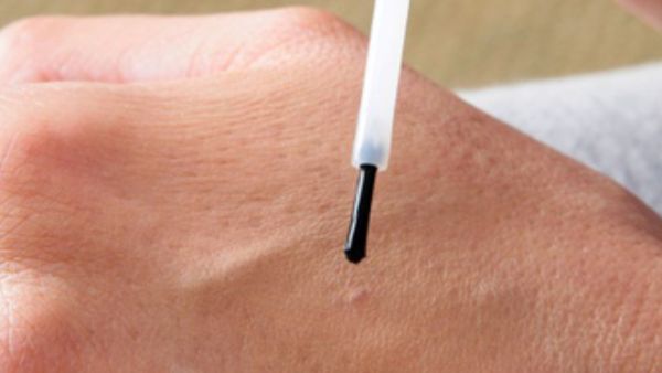 5 علاجات طبية للتخلص من الثآليل