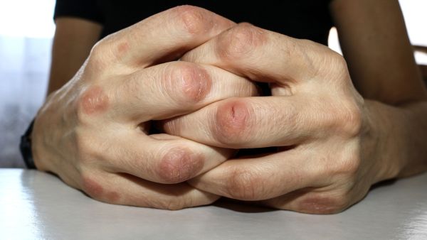 نفجار فقاعات غازيّة في السائل الموجود في المفاصل قد يكون مصدر صوت طقطقة الأصابع