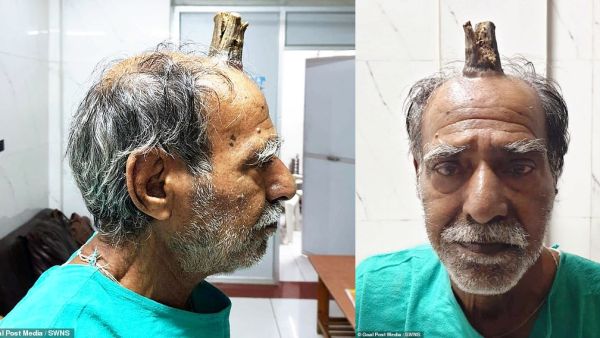 Shyam Lal Yadav, 74, from India, had to have a four-inch horn removed from the top of his head. (Daily Mail)