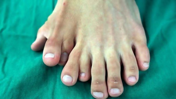 Ajun, 21, from Lufeng City, southern China, was born with a severe deformity which caused him to suffer with nine toes on his left food (dailymail)