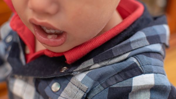 استخدام مراهم موضعية في حال ازداد الألم لدى الطفل