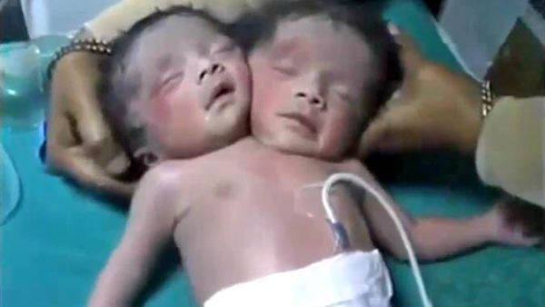 Baby with two heads (Twitter)