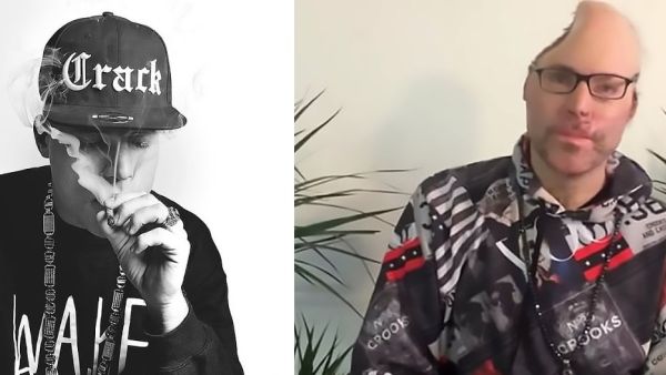 Niko Brennan, whose rapper name is Dr Knarf, is pictured here after surgery to remove a portion of his skull. (Daily Mail)