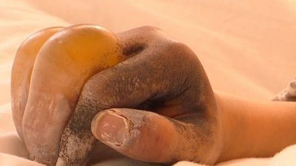 Lu Yanyan's fingers swelled and turned black after she was ordered to work sweep snow (dailymail)