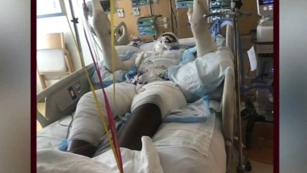 Burned teen warns against YouTube fire challenge. (Twitter) Burned teen warns against YouTube fire challenge. (Twitter)