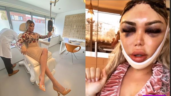 Brave Roddy wore a white bandage around her head as she sported heavily bruised and swollen eyes