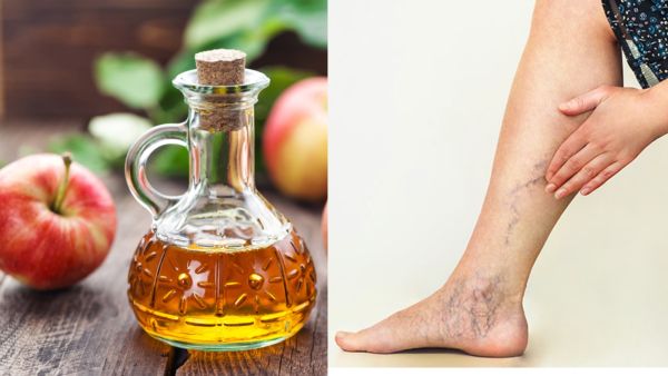 طبيب البوابة: 3 طرق طبيعية للتخلص من الأوردة العنكبوتية