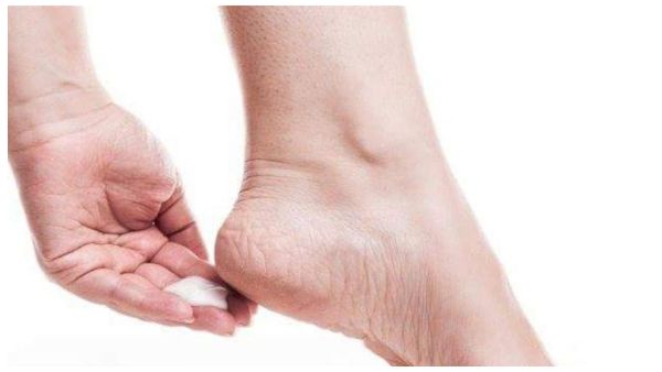 والقضاء على تشقق الكعبين بوصفات سحرية تخلصك من إحراج
