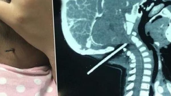 قضيب فولاذي يخترق رأس طفل صيني