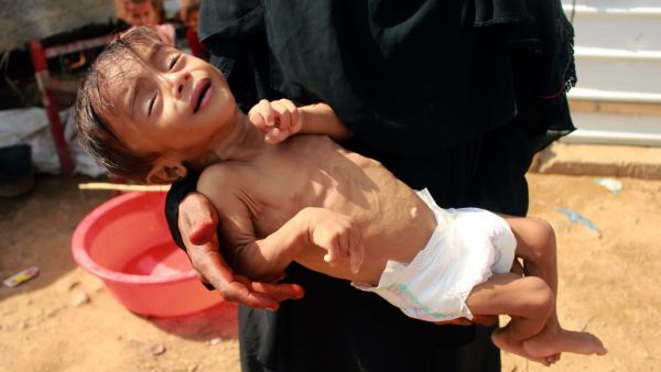 Hashem Mahmoud Atin, a ten-month-old displaced Yemeni child suffering from acute malnutrition and who is unable to reach a hospital for treatment, is held by his mother at a camp in Abs in northern Yemen's Hajjah province on September 3, 2020. Hundreds of children and pregnant women have been negatively affected by the closure of medical clinics funded by the United Nations Children's Fund (UNICEF) in Yemen's displaced camps. ESSA AHMED / AFP