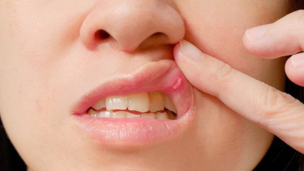  يمكن مواجهة بثور الفم بواسطة مزيج الكركم وعسل النحل