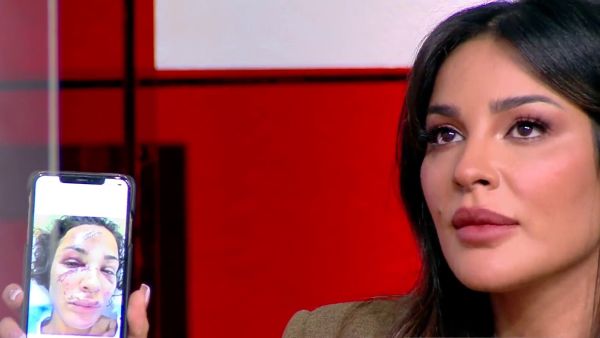 نادين نسيب نجيم تشارك الصُور الأولى لوجهها المتضرر..أسنان مكسورة ودماء تغطي الوجه!