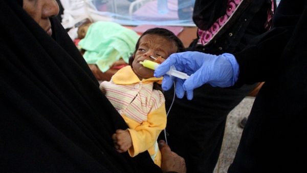 A medic uses a syringe to feed a malnourished child receiving treatment at a health centre in Yemen's northern Hajjah province on March 21, 2021. ESSA AHMED / AFP Children hit hardest in the Yemeni war