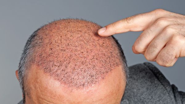 زراعة الشعر في الحلم