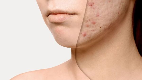 ثبت أن هناك العديد من المكونات الموجودة في التقشير الكيميائي الذي يصرف دون وصفة طبية