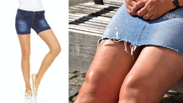 جميلة البوابة: كيفية التعامل مع فرط تصبغ الفخذين