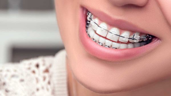 يجب عليكِ الإلتزام بمواعيد طبيب الأسنان لفحص التقويم والتأكد من عدم وجود أي مشكلة