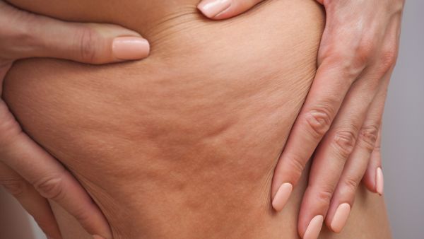 علاجات منزلية للتخلص من السيلوليت على الفخذين