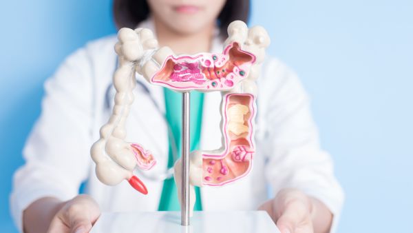 Colorectal Cancer