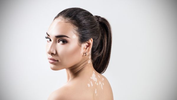 كريم أوبزيلورا Opzelura أول علاج مرخص للبهاق