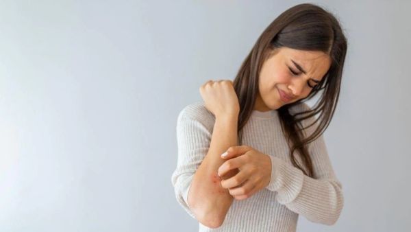 طبيب البوابة: كل ما تحتاج إلى معرفته عن الأكزيما