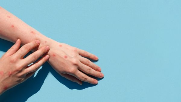 monkeypox cases
