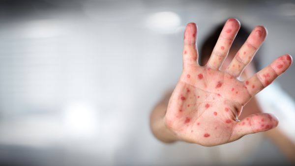 Jordan records 27 measles cases