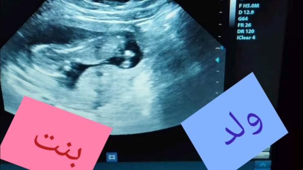 كيف أعرف نوع الجنين في الشهر الثالث بدون سونار