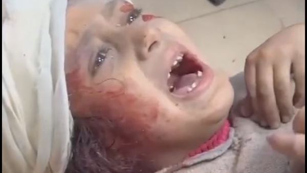 طفلة فلسطينية اصيبت خلال الجريمة الاسرائيلية في غزة