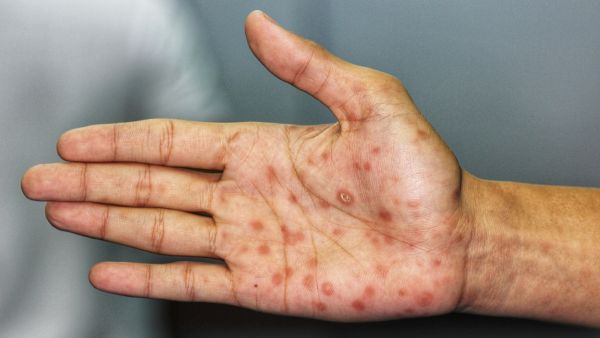 مرض الزهري: مراحله،مضاعفاته، تشخيصه، علاجه