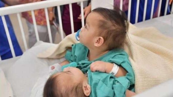  بدء عملية فصل التوأم السيامي أكيزا وعائشة في السعودية