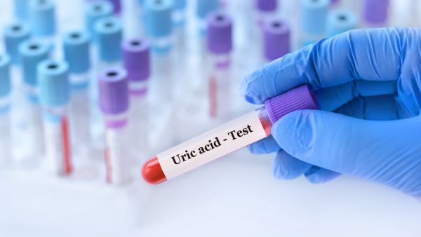 طبيب البوابة: 5 علاجات فعّالة لخفض مستويات حمض البوليك