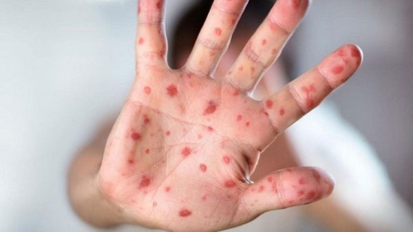 جدري القردة هو مرض نادر تسببه عدوى فيروسية