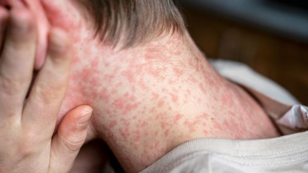 measles outbreak