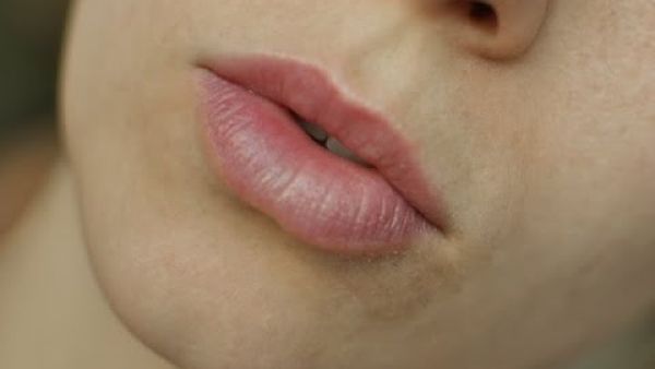 الاسمرار ما حول الفم له العديد من الحلول التجميلية 