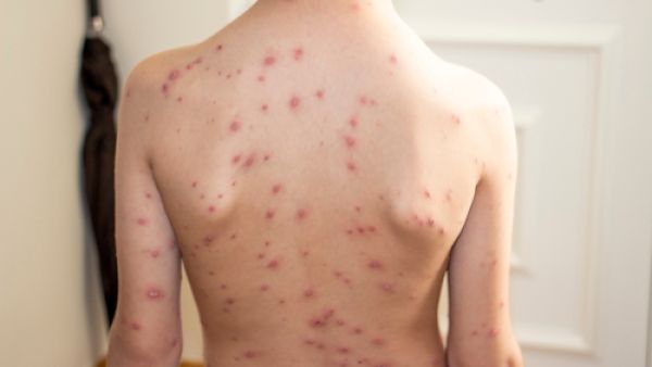 تهدف معالجة الطفل المصاب بالجدري في البيت لتخفيف الحكة المزعجة
