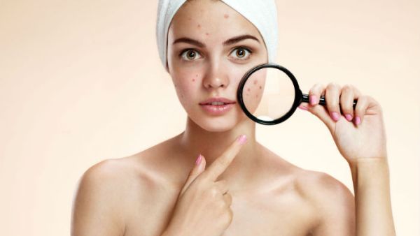 يلعب التوتر دورًا في التسبب بظهور حب الشباب (shutterstock.com)